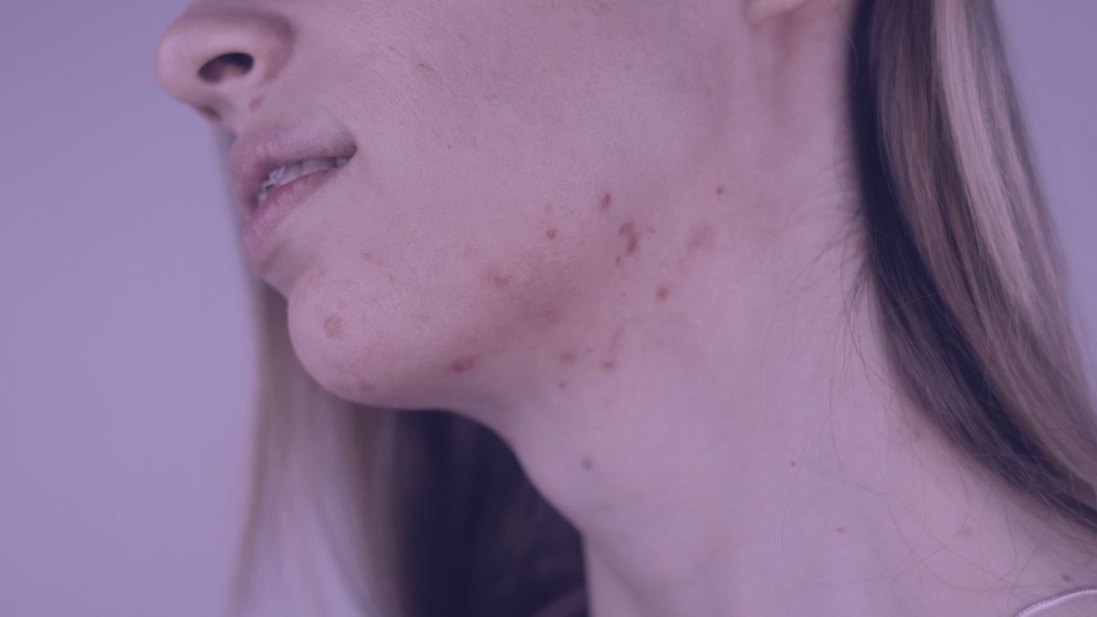 PCOS and acne, highlighting hormonal factors and skincare implications.