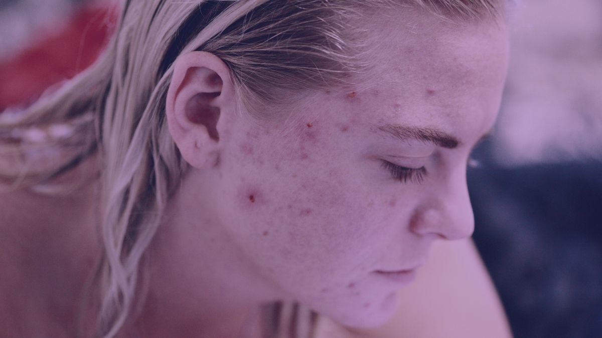 Highlighting effective strategies to eliminate cystic temple acne, providing insights on targeted skincare solutions for tackling this specific type of acne.