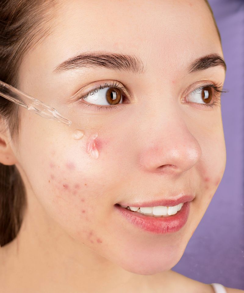 Explaining what an acne serum is and illustrating essential ingredients and application techniques for maximizing its effectiveness in skincare regimens.